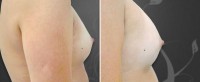 /album/galeria-de-fotos-antes-depois/aqualift-corporal-seios2-hidrogel-poliamida-1-jpg/